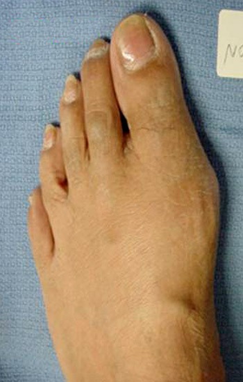 bunion deformity of both feet