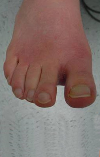 Normal position of the big toe