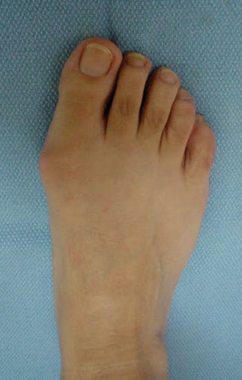 35 year old female with bunion deformity of the right foot