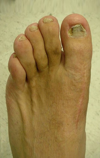 Excellent correction of the deformity using the previous incision on the top of the foot
