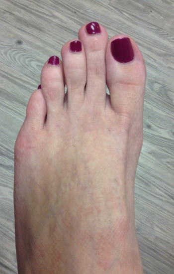 Before & After Bunion Surgery Photo Gallery, Los Angeles Foot Doctor