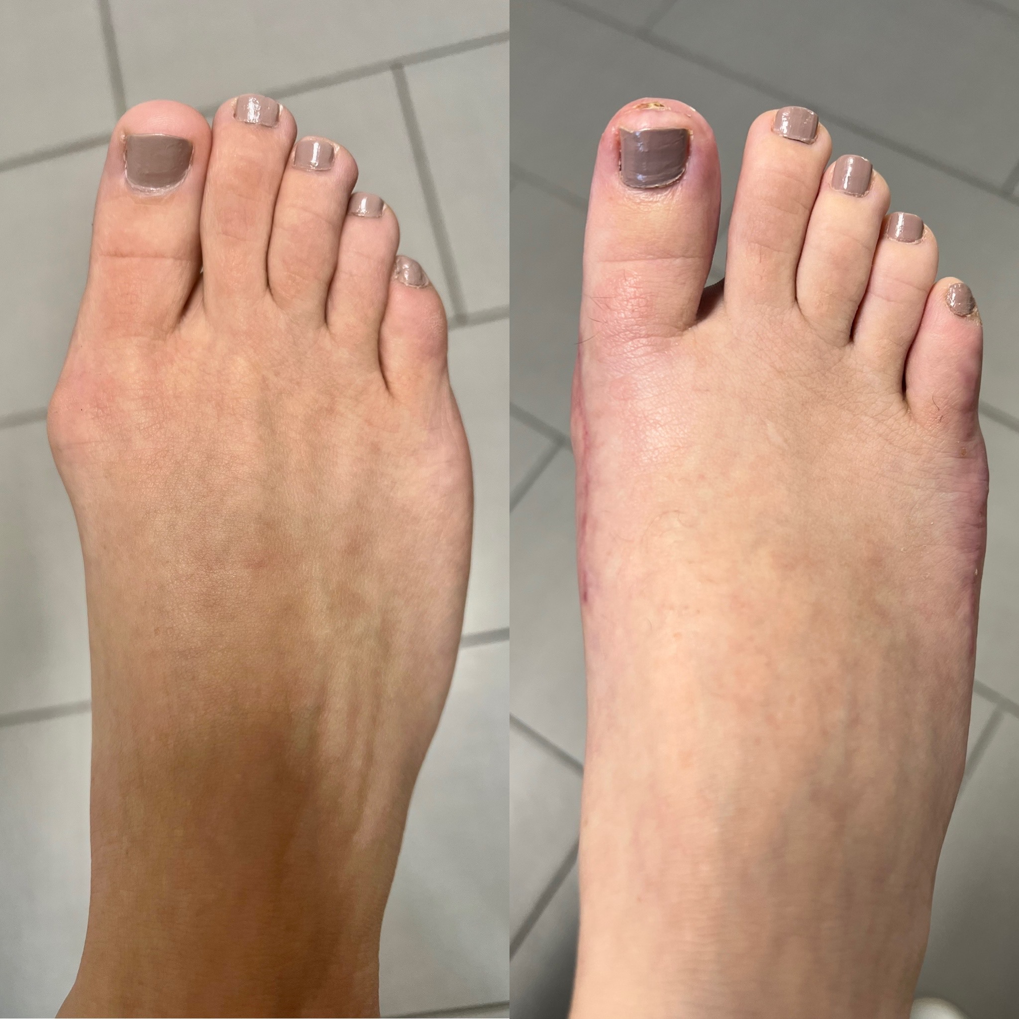 SURGERY FOR WIDE FEET? WAIT UNTIL YOU SEE THIS !!! (BEFORE & AFTER